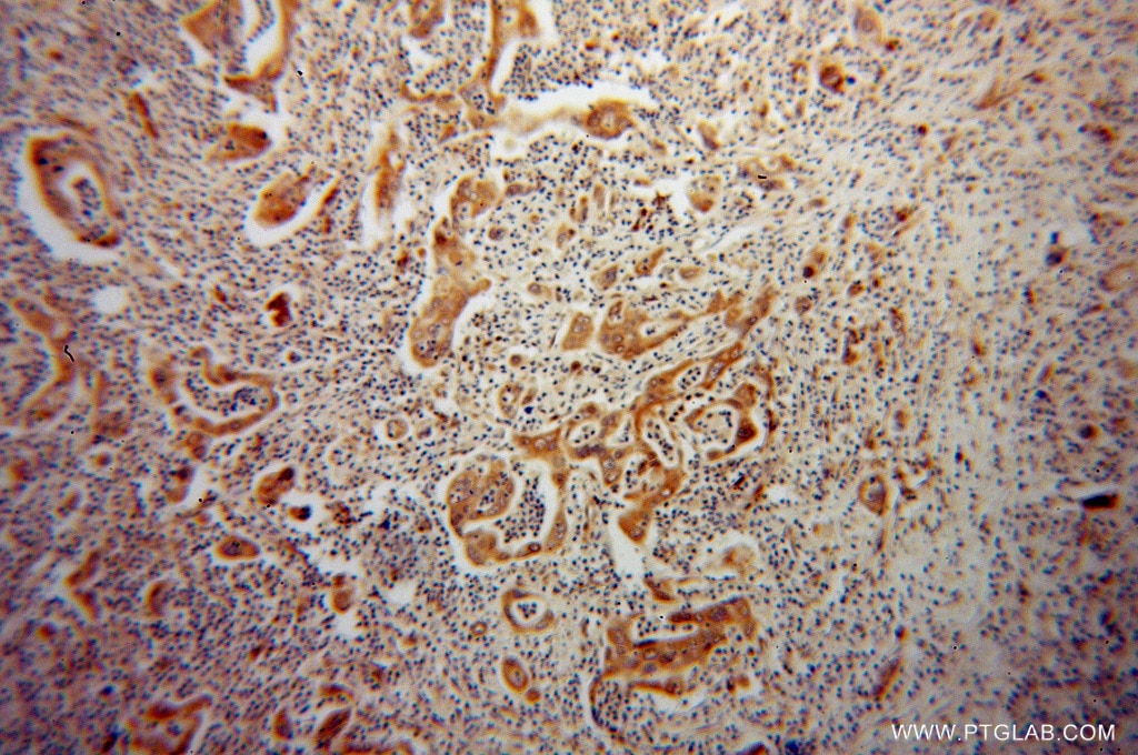 Immunohistochemistry (IHC) staining of human pancreas cancer tissue using ISYNA1 Polyclonal antibody (14142-1-AP)