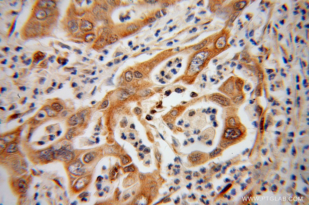 Immunohistochemistry (IHC) staining of human pancreas cancer tissue using ISYNA1 Polyclonal antibody (14142-1-AP)