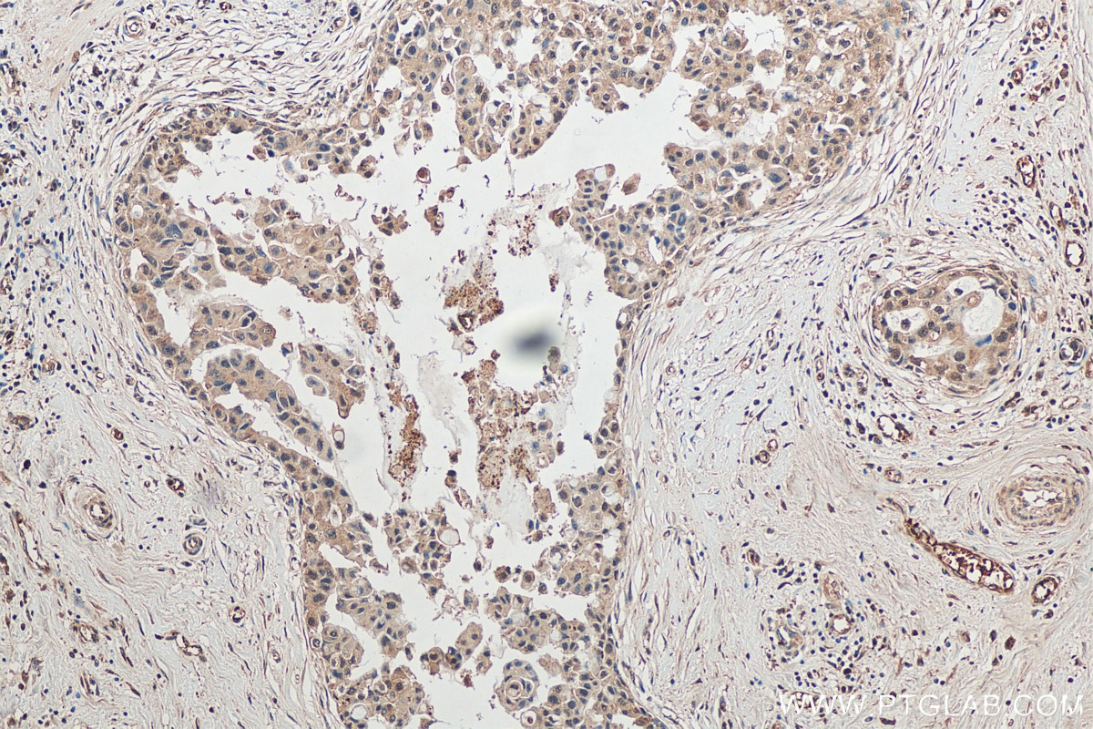 Immunohistochemistry (IHC) staining of human breast cancer tissue using ITCH Polyclonal antibody (20920-1-AP)