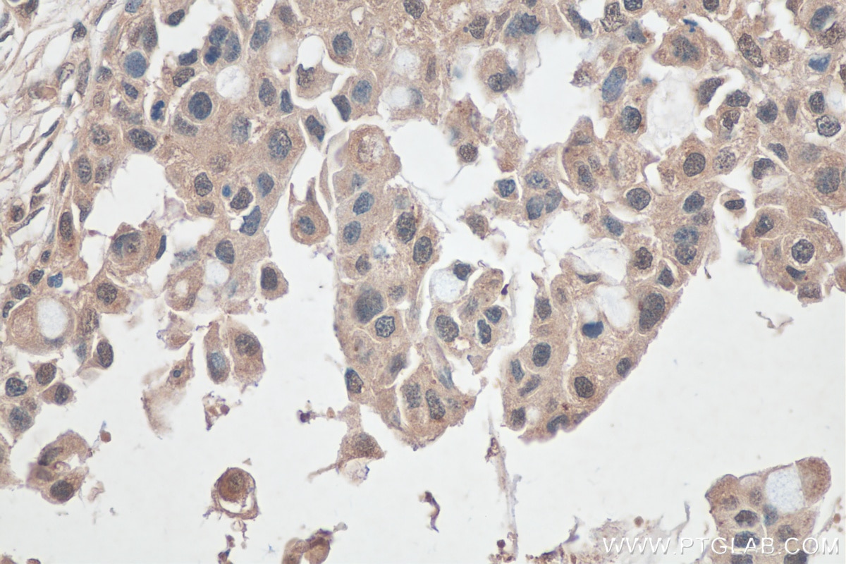 Immunohistochemistry (IHC) staining of human breast cancer tissue using ITCH Polyclonal antibody (20920-1-AP)