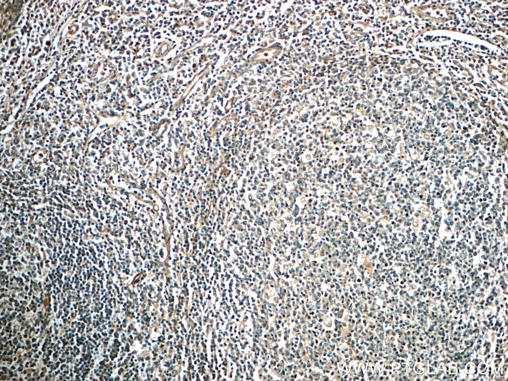 IHC staining of human tonsillitis using 22146-1-AP