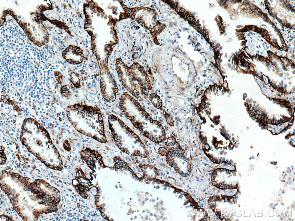Immunohistochemistry (IHC) staining of human lung cancer tissue using Integrin Alpha 3 Monoclonal antibody (66070-1-Ig)