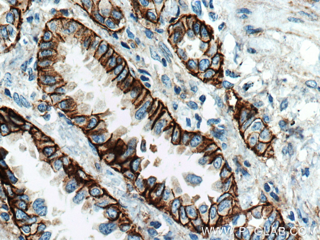 Immunohistochemistry (IHC) staining of human lung cancer tissue using Integrin Alpha 3 Monoclonal antibody (66070-1-Ig)