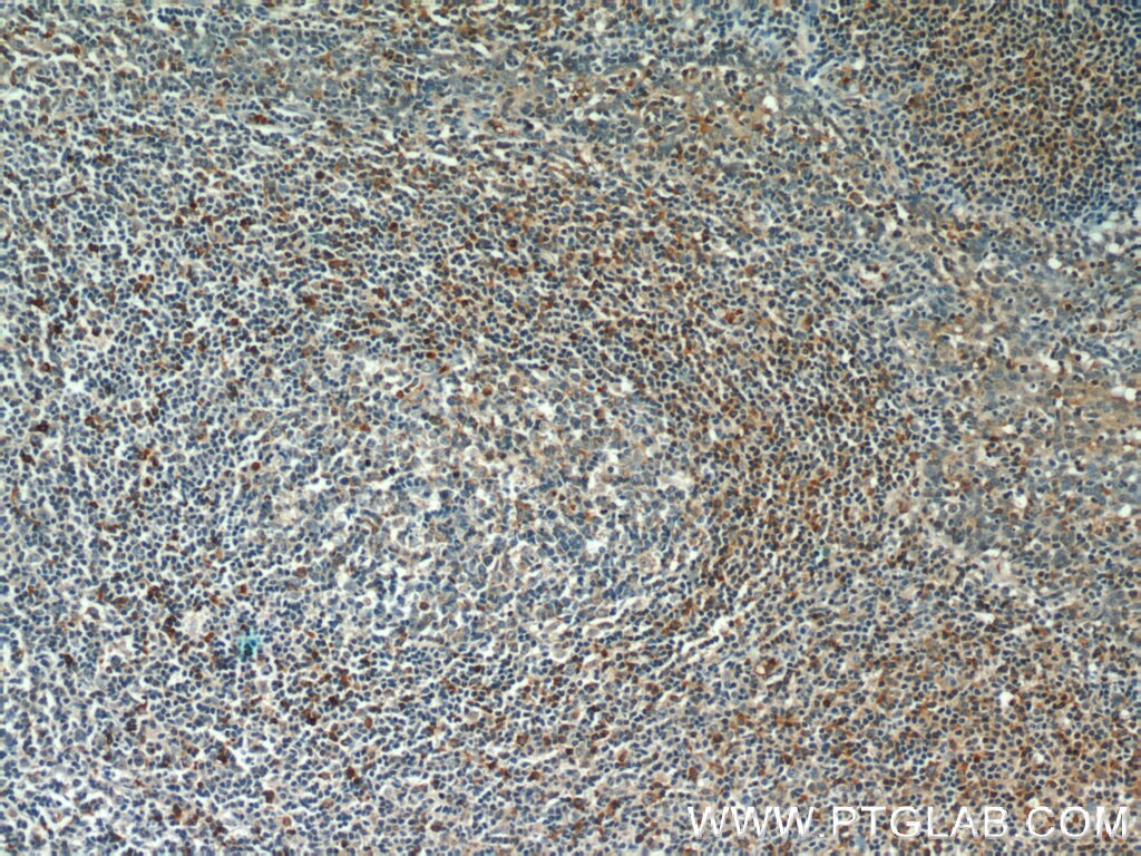 Immunohistochemistry (IHC) staining of human tonsillitis tissue using Integrin Alpha 4 Polyclonal antibody (19676-1-AP)