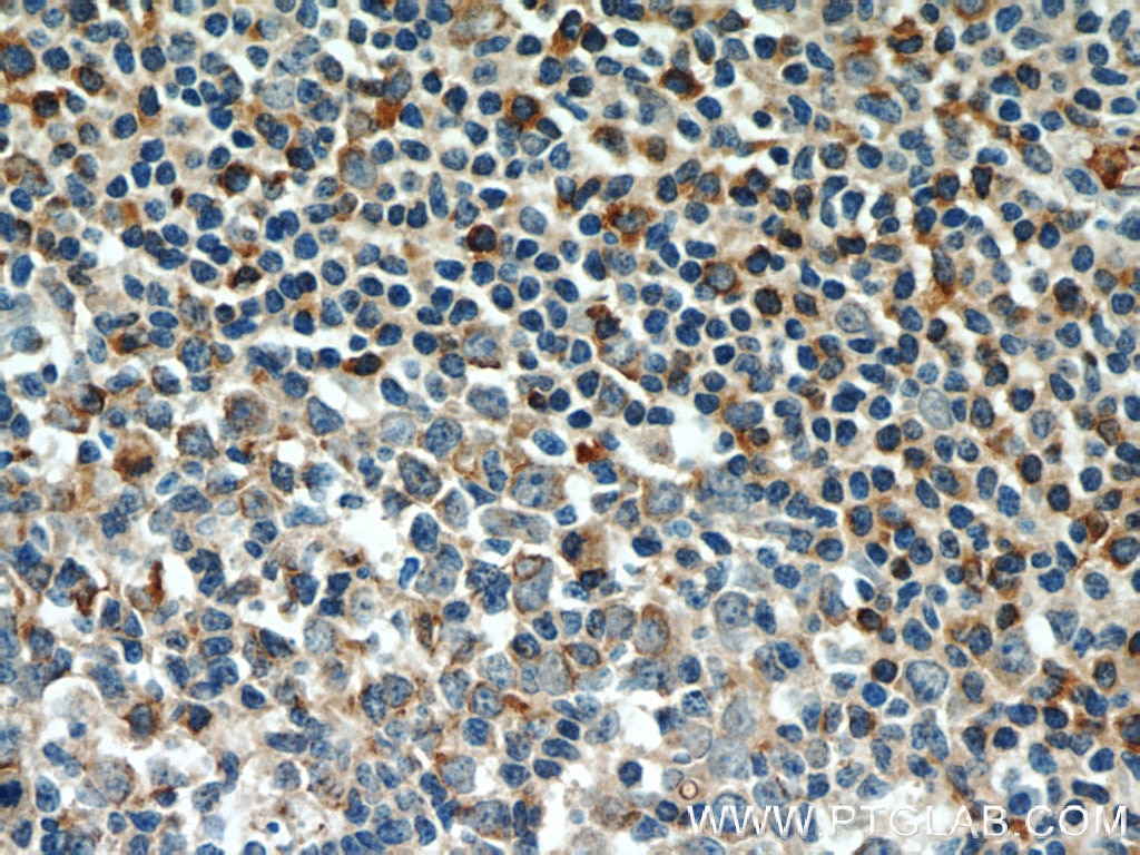 Immunohistochemistry (IHC) staining of human tonsillitis tissue using Integrin Alpha 4 Polyclonal antibody (19676-1-AP)