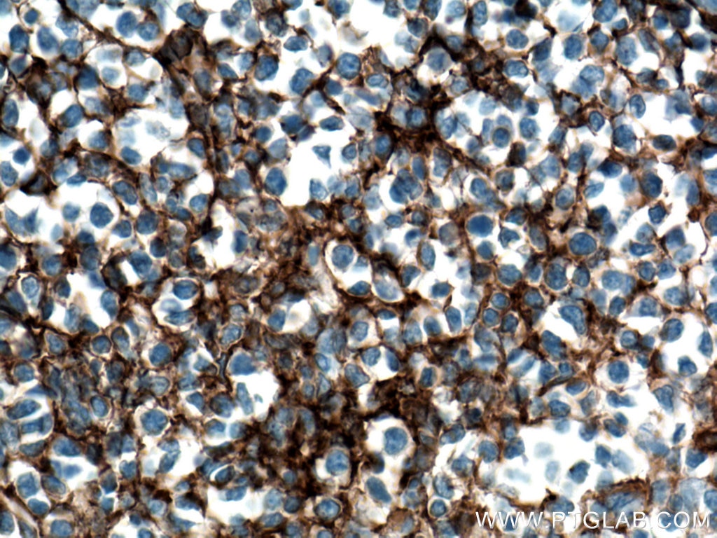 Immunohistochemistry (IHC) staining of human tonsillitis tissue using CD11B/Integrin Alpha M Polyclonal antibody (21851-1-AP)