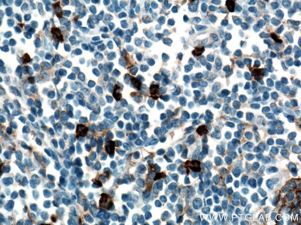 Immunohistochemistry (IHC) staining of human tonsillitis tissue using CD11B/Integrin Alpha M Polyclonal antibody (21851-1-AP)