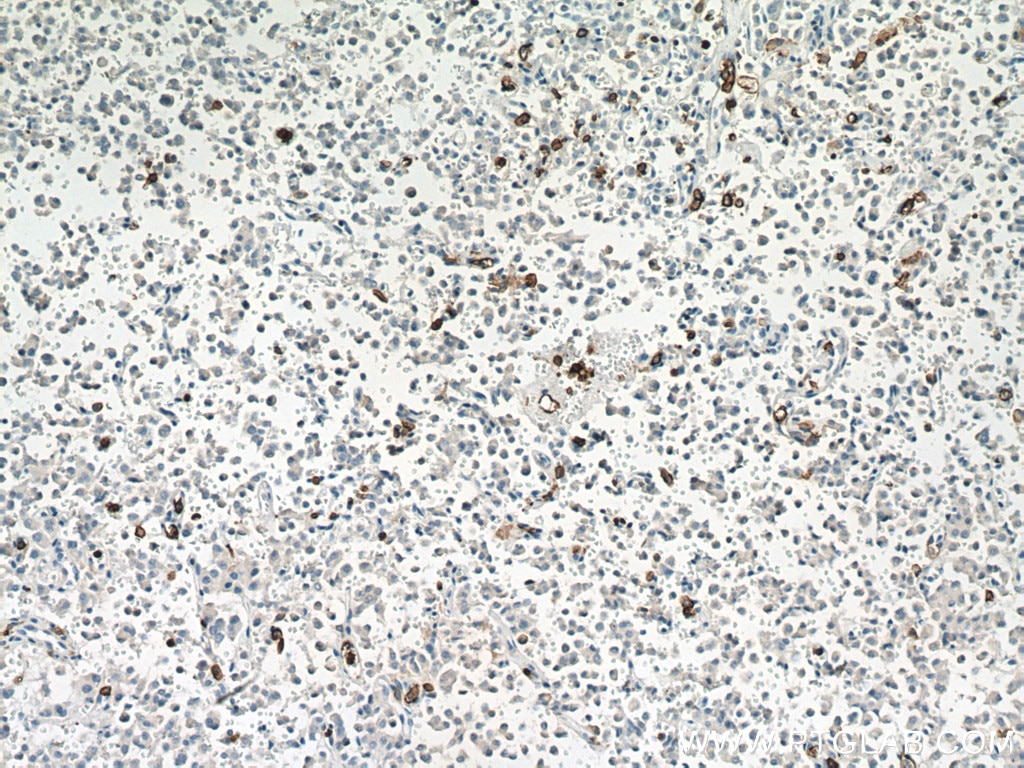 Immunohistochemistry (IHC) staining of Insulinoma tissue using CD11B/Integrin Alpha M Polyclonal antibody (21851-1-AP)