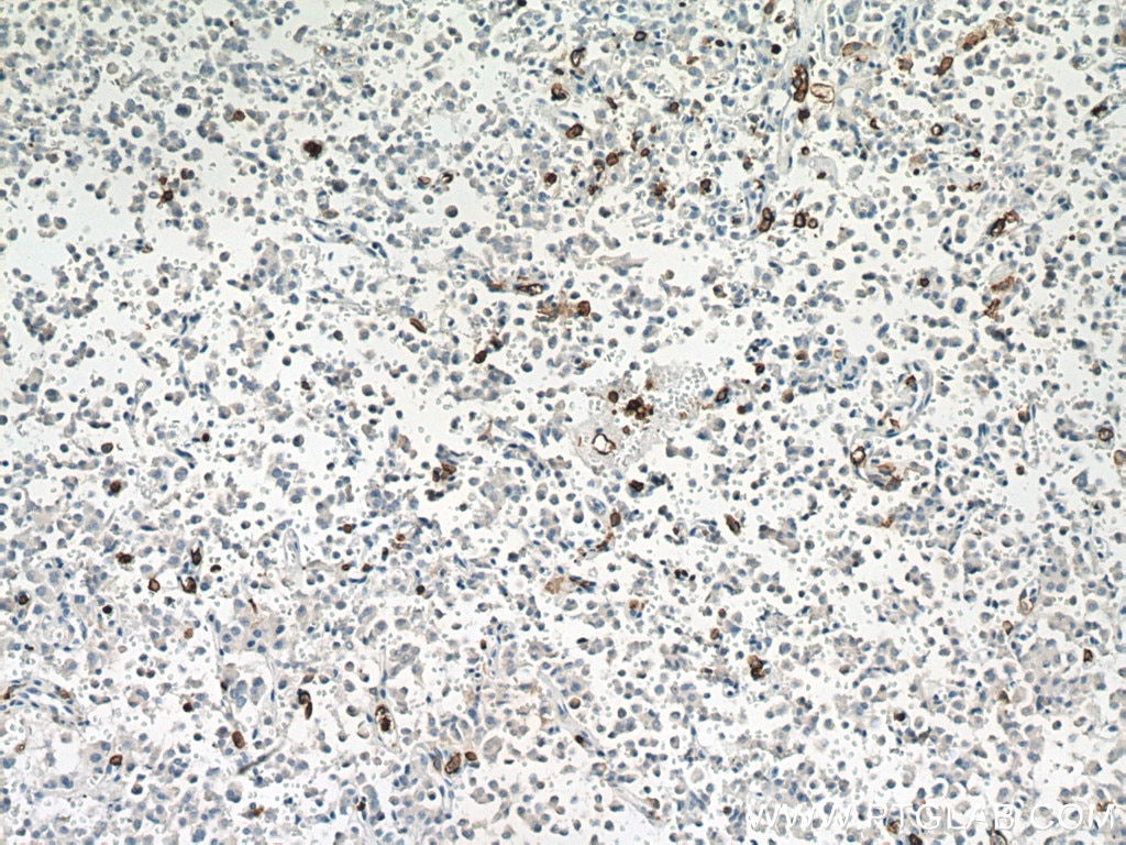 IHC staining of Insulinoma using 21851-1-AP