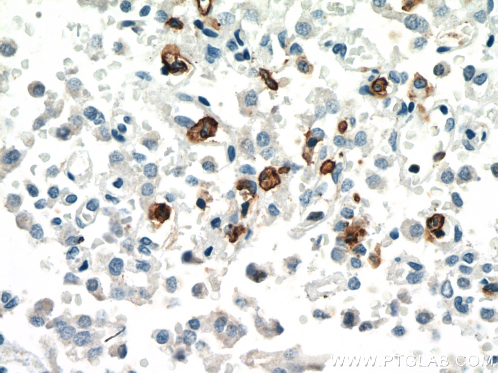 Immunohistochemistry (IHC) staining of Insulinoma tissue using CD11B/Integrin Alpha M Polyclonal antibody (21851-1-AP)