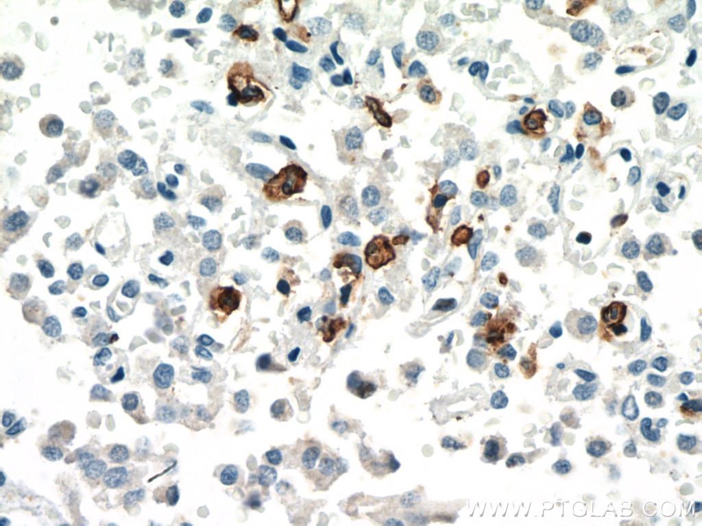 IHC staining of Insulinoma using 21851-1-AP