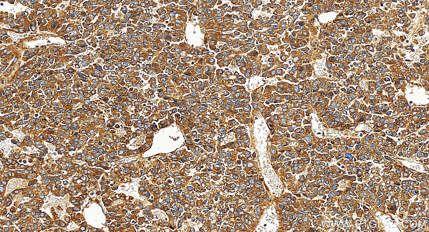 Immunohistochemical analysis of paraffin-embedded human Hepatocellular carcinoma slide using 27096-1-AP (Integrin Alpha V antibody) at dilution of 1:1000 (under 20x lens). Heat mediated antigen retrieval with Tris-EDTA buffer (pH 9.0). Immunohistochemistry (IHC) staining of human Hepatocellular carcinoma using Integrin Alpha V Polyclonal antibody (27096-1-AP)