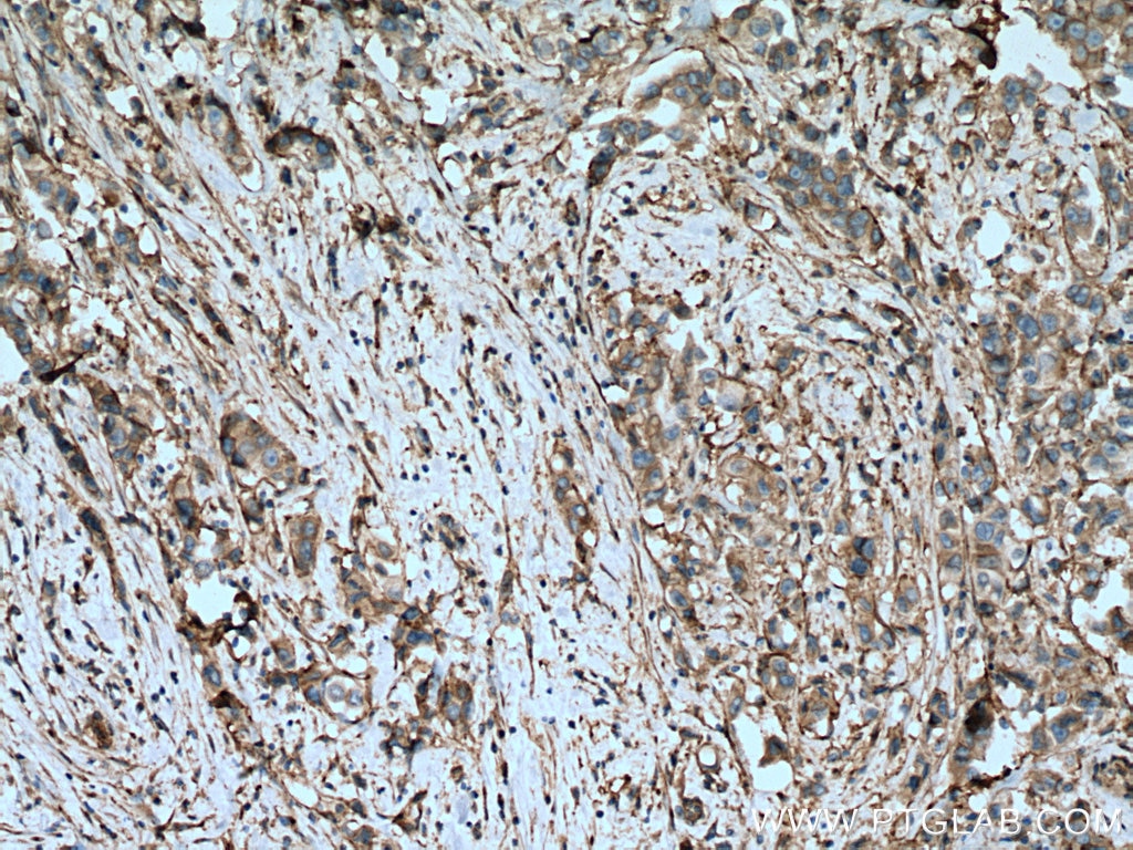 IHC staining of human breast cancer using 27096-1-AP
