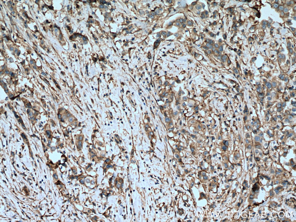 Immunohistochemistry (IHC) staining of human breast cancer tissue using Integrin Alpha V Polyclonal antibody (27096-1-AP)