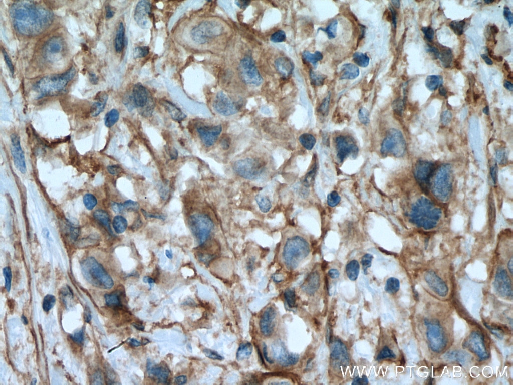 Immunohistochemistry (IHC) staining of human breast cancer tissue using Integrin Alpha V Polyclonal antibody (27096-1-AP)