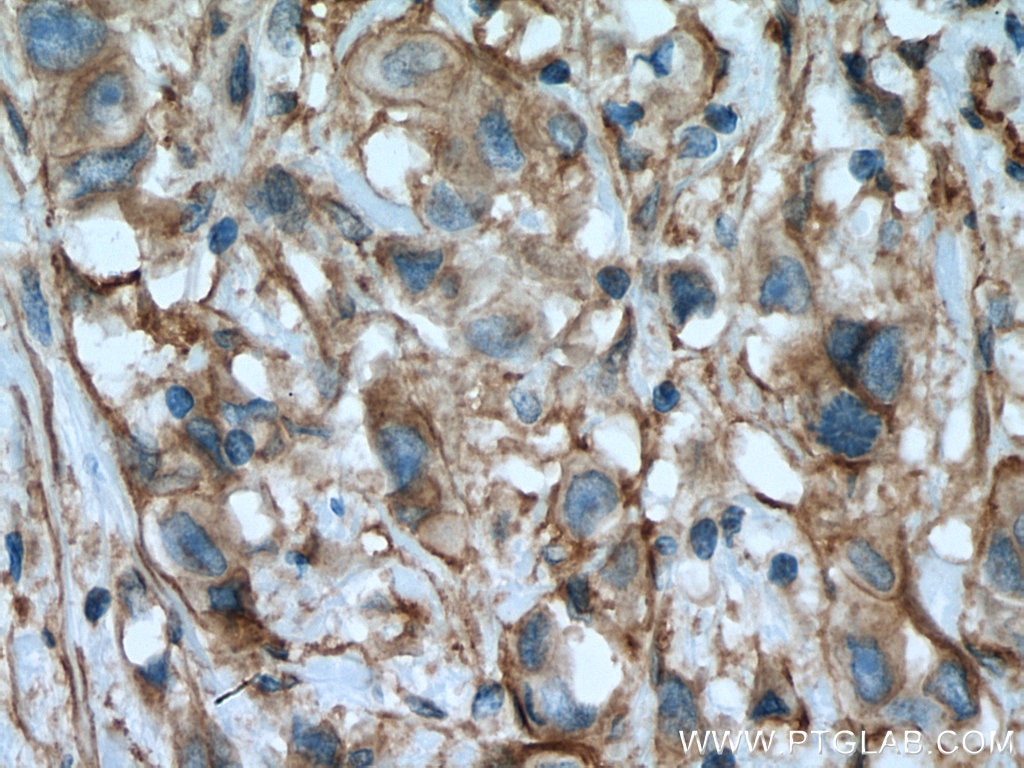 IHC staining of human breast cancer using 27096-1-AP