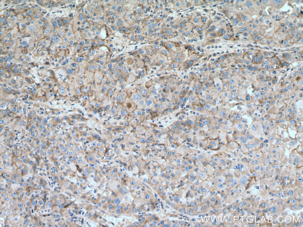 Immunohistochemistry (IHC) staining of human liver cancer tissue using Integrin Alpha V Polyclonal antibody (27096-1-AP)