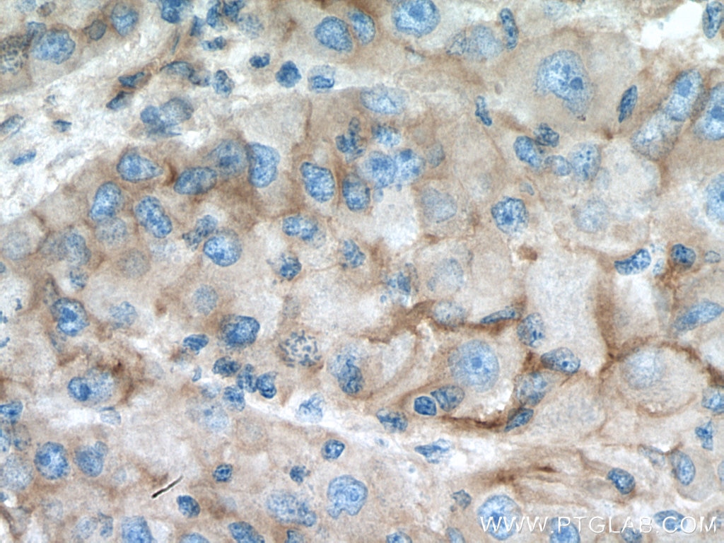 Immunohistochemistry (IHC) staining of human liver cancer tissue using Integrin Alpha V Polyclonal antibody (27096-1-AP)