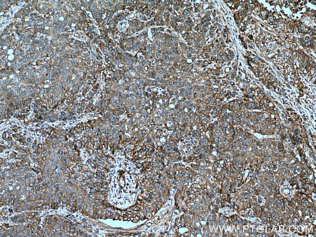 Immunohistochemistry (IHC) staining of human stomach cancer tissue using Integrin Alpha V Polyclonal antibody (27096-1-AP)