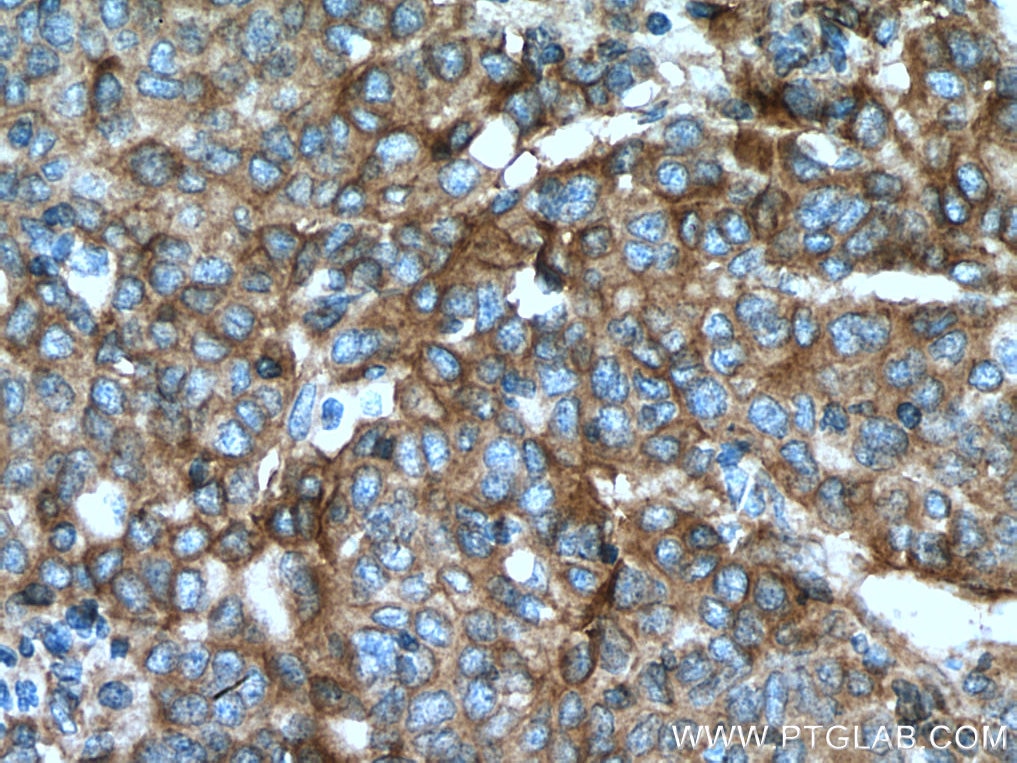 Immunohistochemistry (IHC) staining of human stomach cancer tissue using Integrin Alpha V Polyclonal antibody (27096-1-AP)