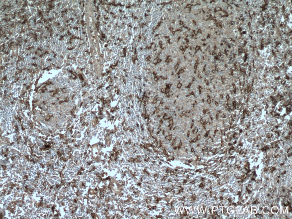 Immunohistochemistry (IHC) staining of human tonsillitis tissue using CD11c/Integrin Alpha X Polyclonal antibody (17342-1-AP)