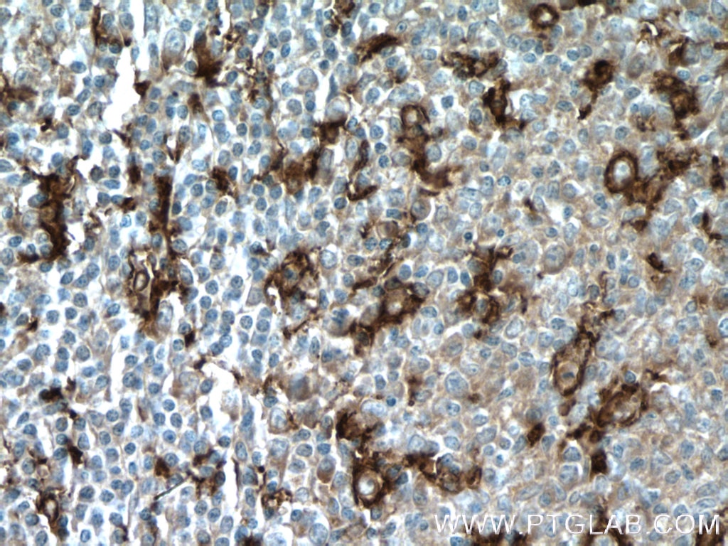 Immunohistochemistry (IHC) staining of human tonsillitis tissue using CD11c/Integrin Alpha X Polyclonal antibody (17342-1-AP)