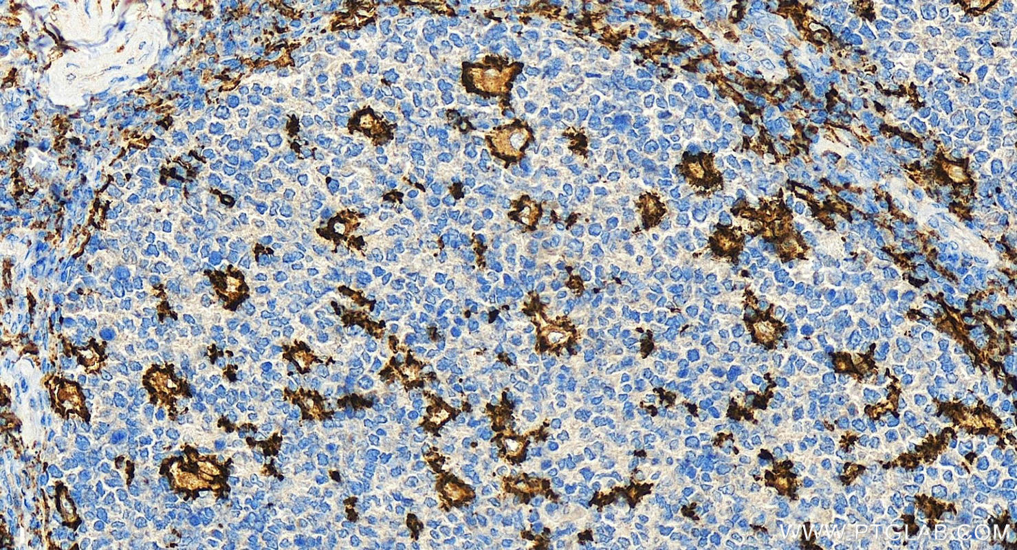 Immunohistochemistry (IHC) staining of human tonsillitis tissue using CD11c Polyclonal antibody (17342-1-AP)