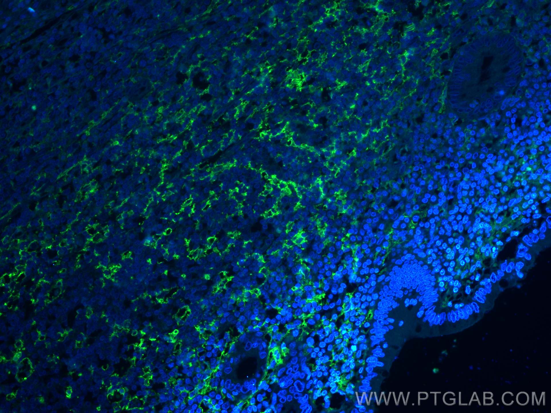 Immunofluorescence (IF) / fluorescent staining of human appendicitis tissue using CD11c/Integrin Alpha X Monoclonal antibody (60258-1-Ig)