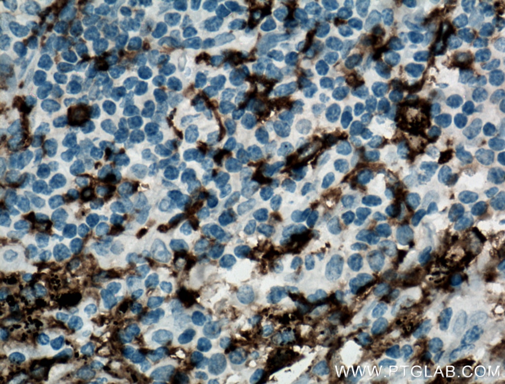 Immunohistochemistry (IHC) staining of human lung cancer tissue using CD11c/Integrin Alpha X Monoclonal antibody (60258-1-Ig)