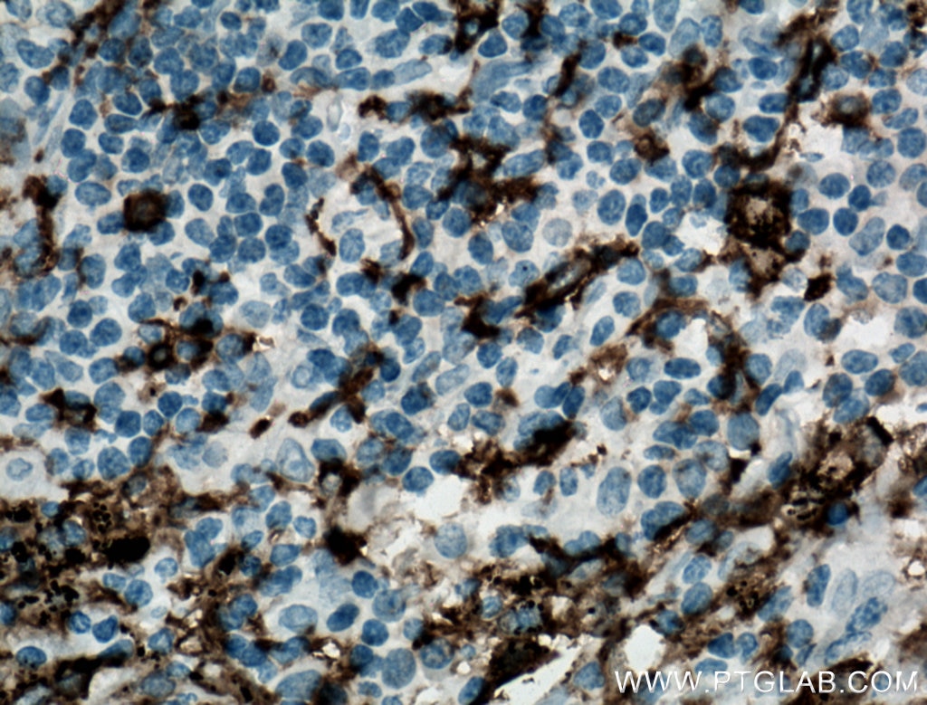 IHC staining of human lung cancer using 60258-1-Ig