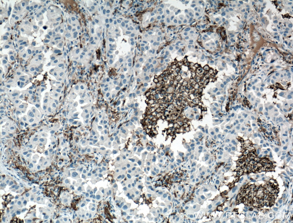 IHC staining of human lung cancer using 60258-1-Ig