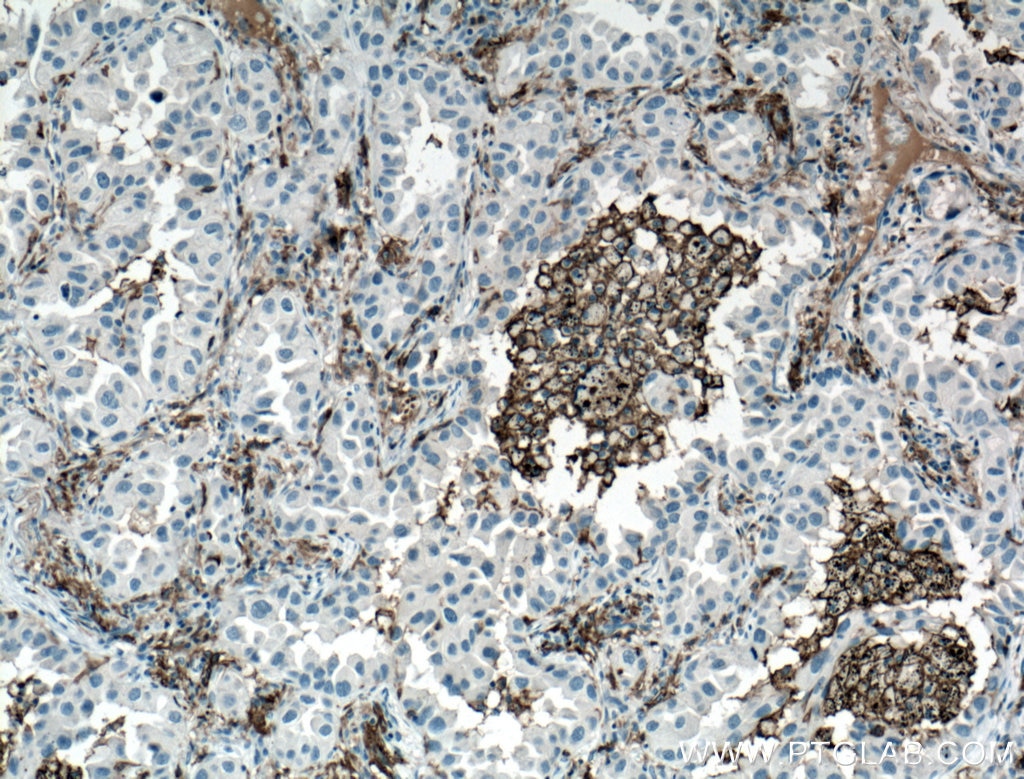 Immunohistochemistry (IHC) staining of human lung cancer tissue using CD11c/Integrin Alpha X Monoclonal antibody (60258-1-Ig)