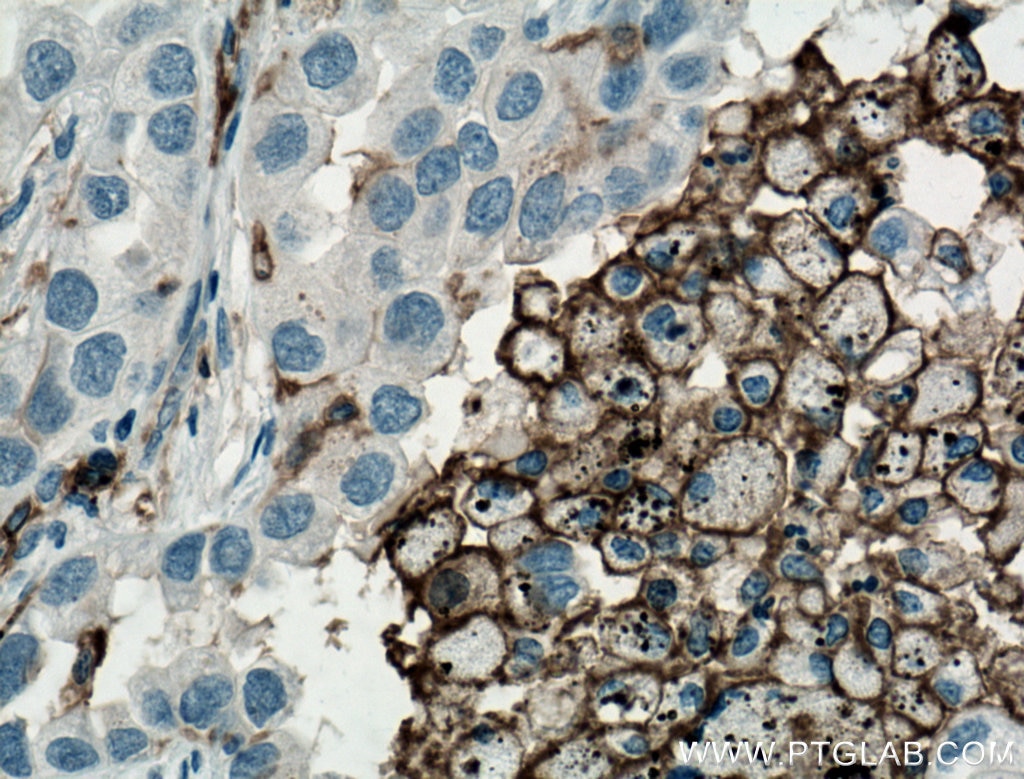 Immunohistochemistry (IHC) staining of human lung cancer tissue using CD11c/Integrin Alpha X Monoclonal antibody (60258-1-Ig)