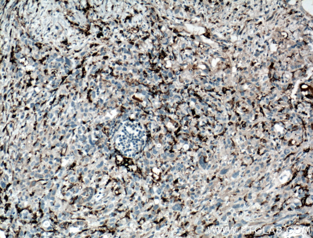 Immunohistochemistry (IHC) staining of human lung cancer tissue using CD11c/Integrin Alpha X Monoclonal antibody (60258-1-Ig)