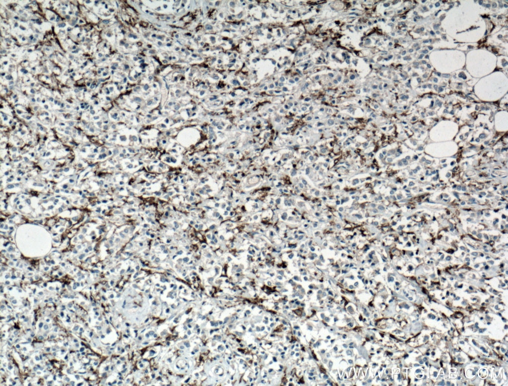 IHC staining of human breast cancer using 60258-1-Ig