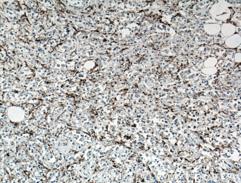 Immunohistochemistry (IHC) staining of human breast cancer tissue using CD11c/Integrin Alpha X Monoclonal antibody (60258-1-Ig)