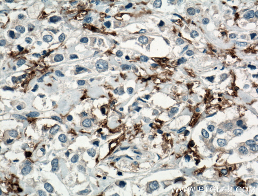 Immunohistochemistry (IHC) staining of human breast cancer tissue using CD11c/Integrin Alpha X Monoclonal antibody (60258-1-Ig)