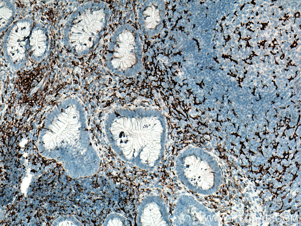 Immunohistochemistry (IHC) staining of human appendicitis tissue using CD11c/Integrin Alpha X Monoclonal antibody (60258-1-Ig)