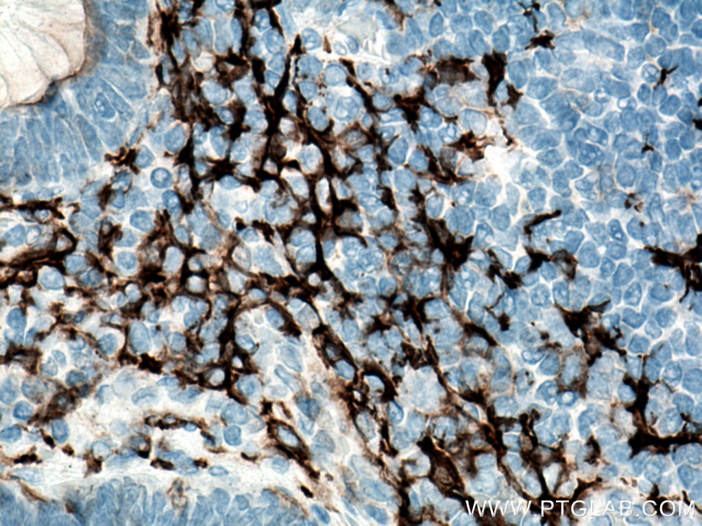 Immunohistochemistry (IHC) staining of human appendicitis tissue using CD11c/Integrin Alpha X Monoclonal antibody (60258-1-Ig)