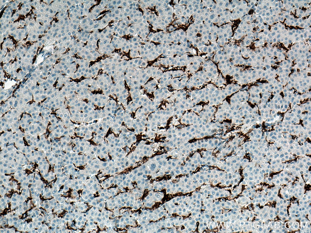 Immunohistochemistry (IHC) staining of human liver cancer tissue using CD11c/Integrin Alpha X Monoclonal antibody (60258-1-Ig)