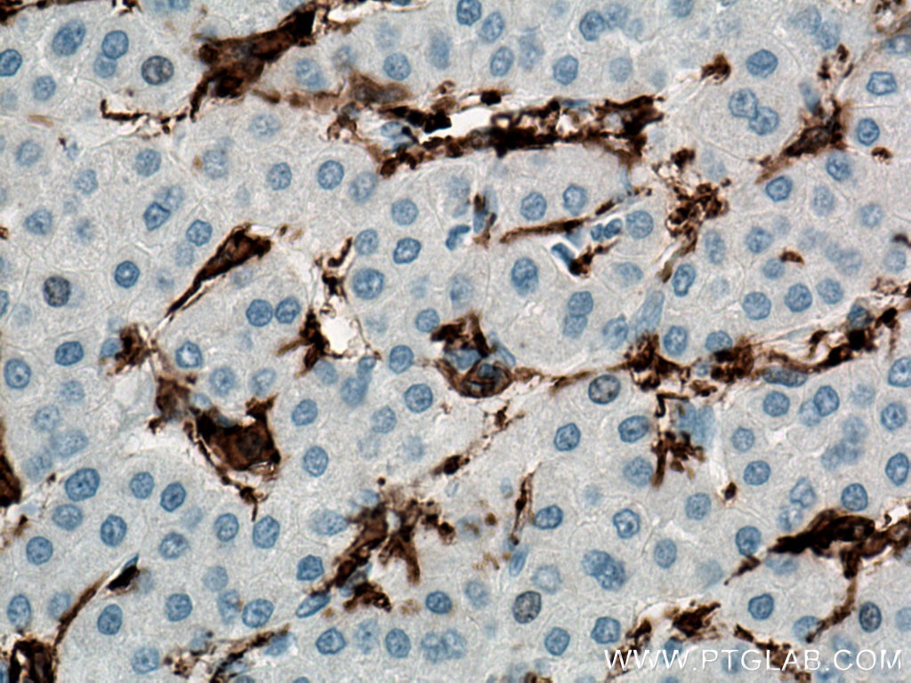 Immunohistochemistry (IHC) staining of human liver cancer tissue using CD11c/Integrin Alpha X Monoclonal antibody (60258-1-Ig)