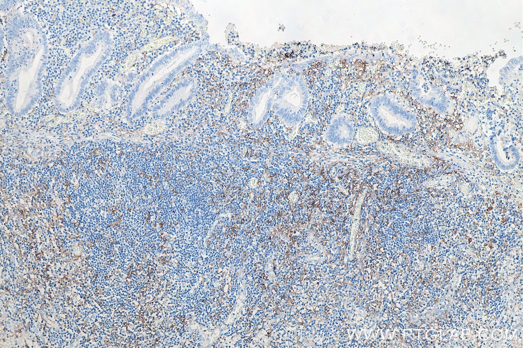 Immunohistochemistry (IHC) staining of human appendicitis tissue using CD11c Monoclonal antibody (60258-1-Ig)