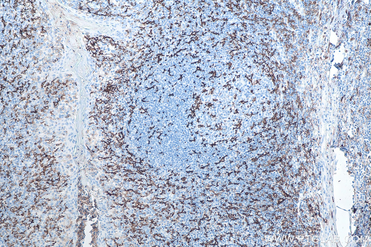 Immunohistochemistry (IHC) staining of human tonsillitis tissue using CD11c/Integrin Alpha X Monoclonal antibody (60258-1-Ig)