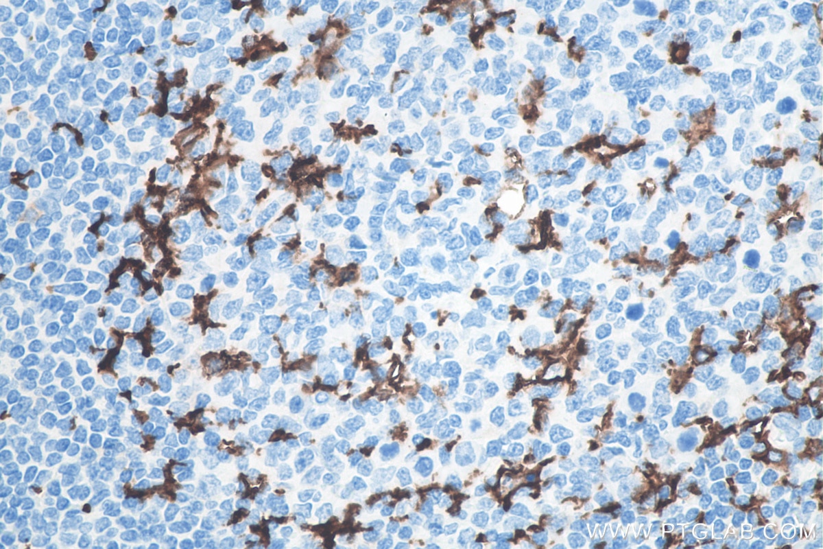 IHC staining of human tonsillitis using 60258-1-Ig