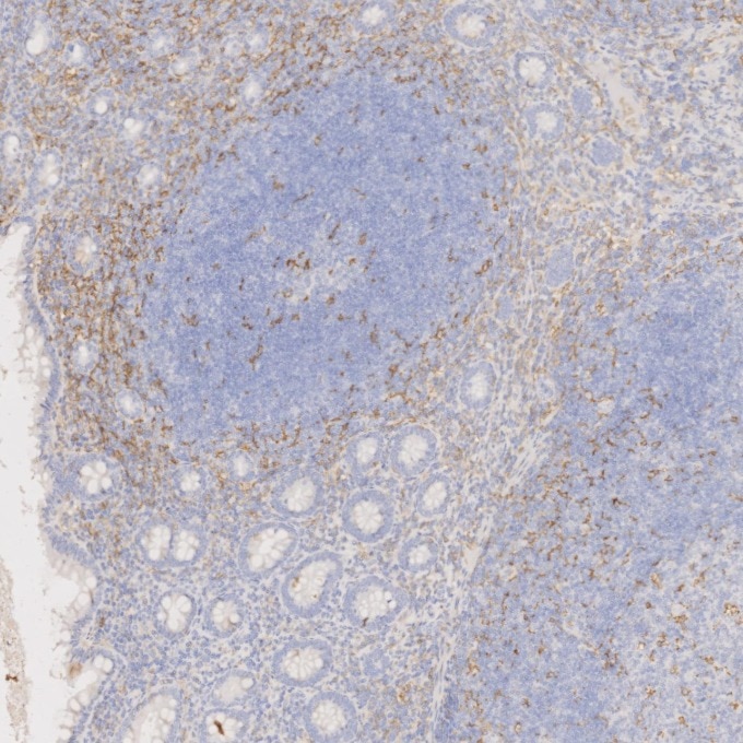 Immunohistochemistry (IHC) staining of human appendicitis tissue using CD11c Monoclonal antibody (60258-1-Ig)