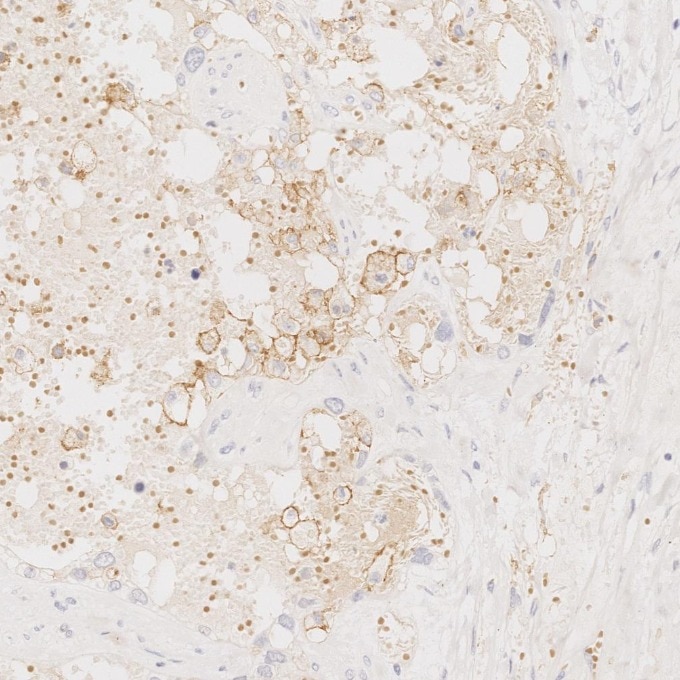 Immunohistochemistry (IHC) staining of human ovary cancer tissue using CD11c Monoclonal antibody (60258-1-Ig)