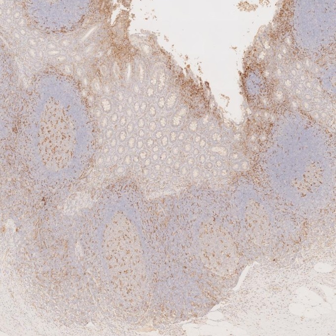 Immunohistochemistry (IHC) staining of human appendicitis tissue using CD11c Monoclonal antibody (60258-1-Ig)