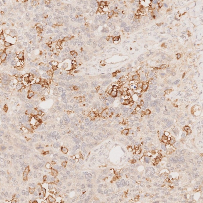 Immunohistochemistry (IHC) staining of human ovary cancer tissue using CD11c Monoclonal antibody (60258-1-Ig)