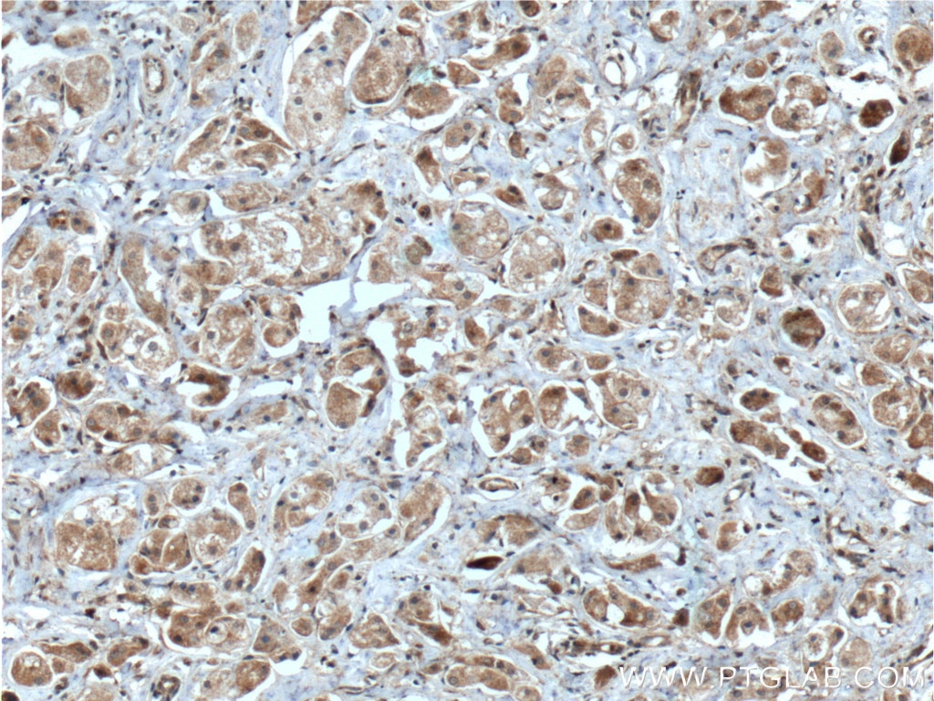 Immunohistochemistry (IHC) staining of human breast cancer tissue using Integrin Beta 1 Polyclonal antibody (12594-1-AP)