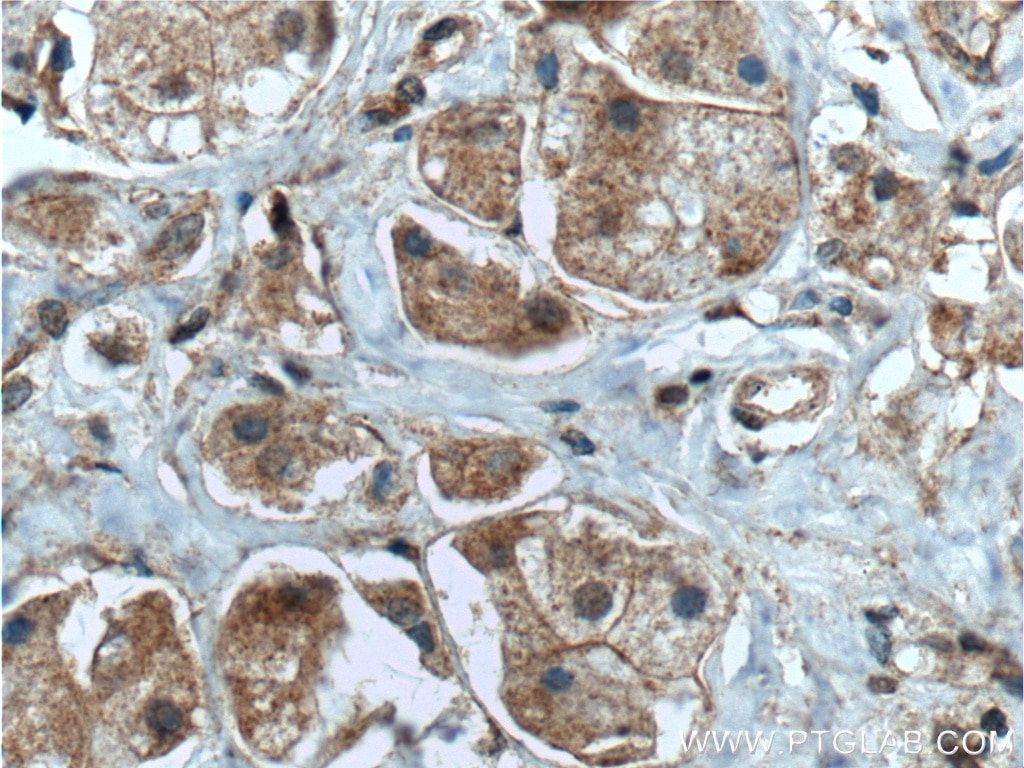 Immunohistochemistry (IHC) staining of human breast cancer tissue using Integrin Beta 1 Polyclonal antibody (12594-1-AP)